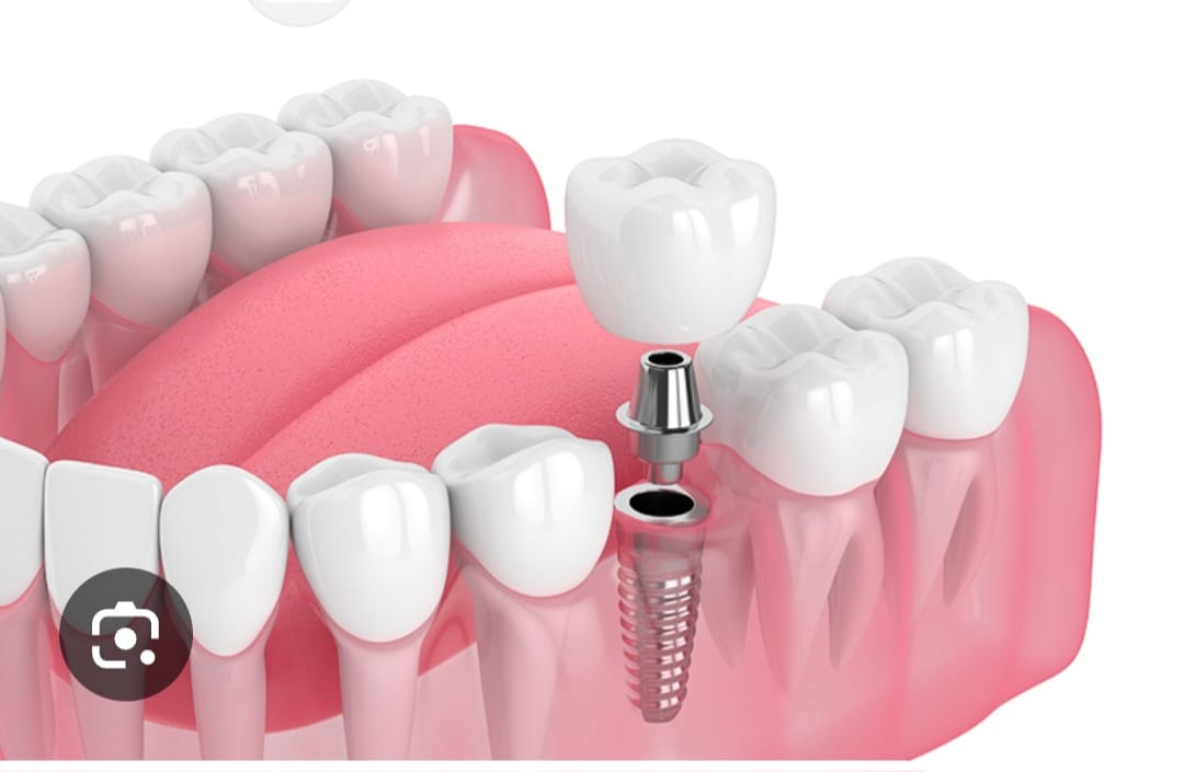 Implantes Dentales de Titanio - Cirugía guiada y rehabilitación oral completa en Vic y Castell